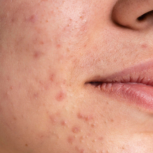 Acne control